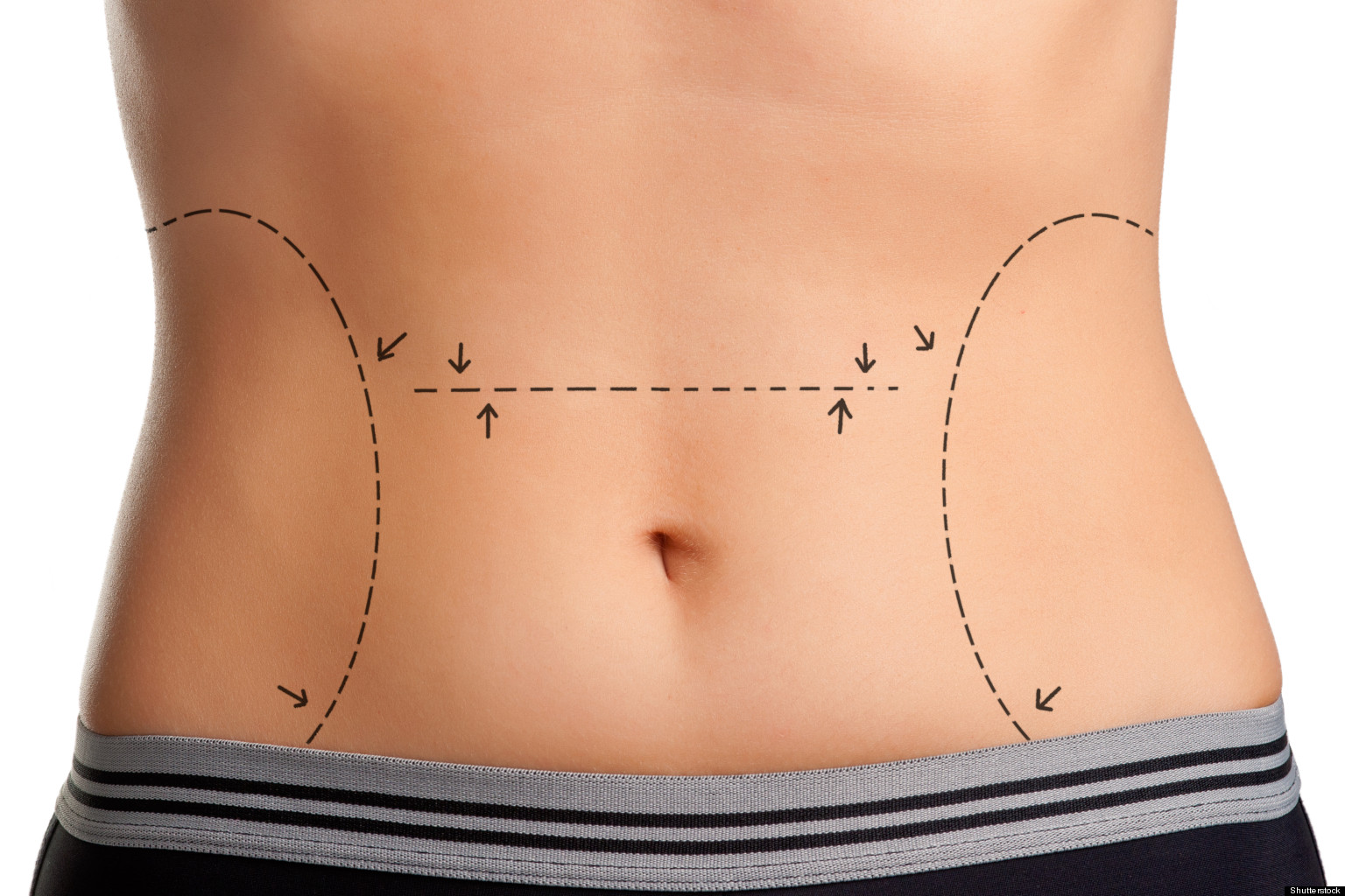 Tummy Tuck