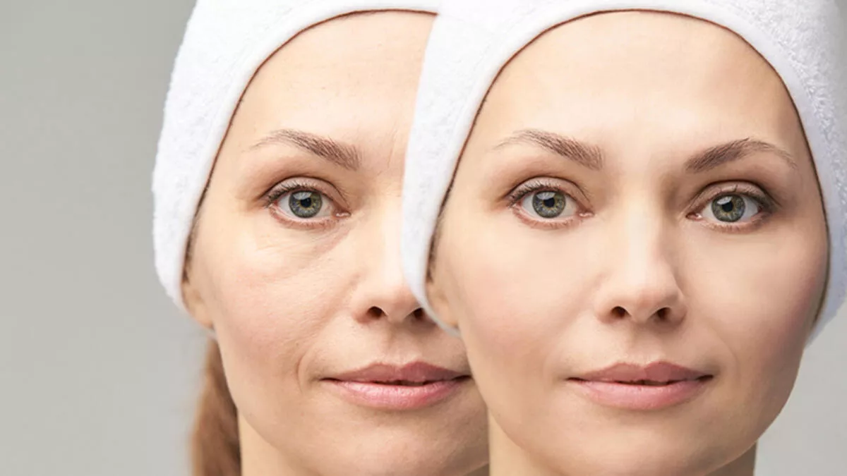 Under-Eye Filler